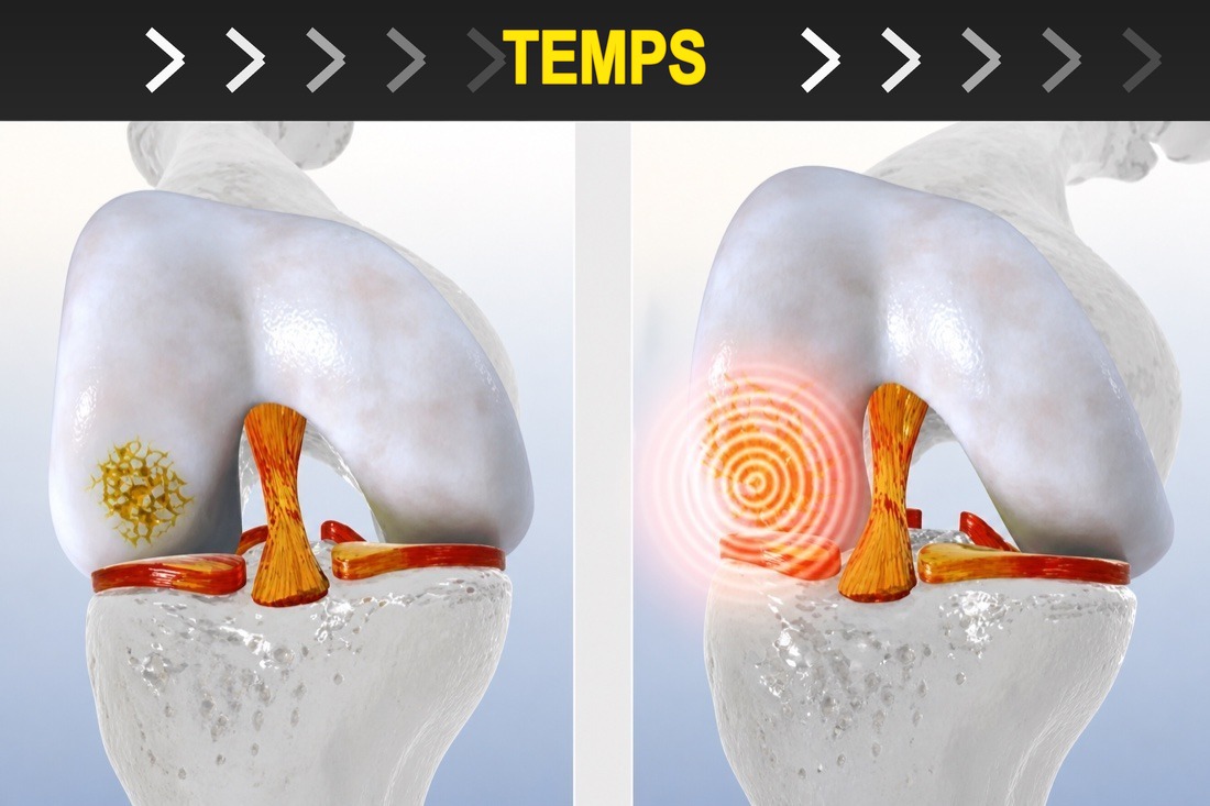 Knee cartilage damage and support over time